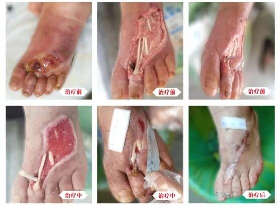 糖尿病并發(fā)癥有多可怕，及時治療糖尿病足避免截肢！