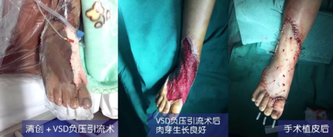 車禍猛如虎，救治如“華佗” ，手術(shù)＋康復(fù)，8歲小女孩車禍后日漸康復(fù)行走
