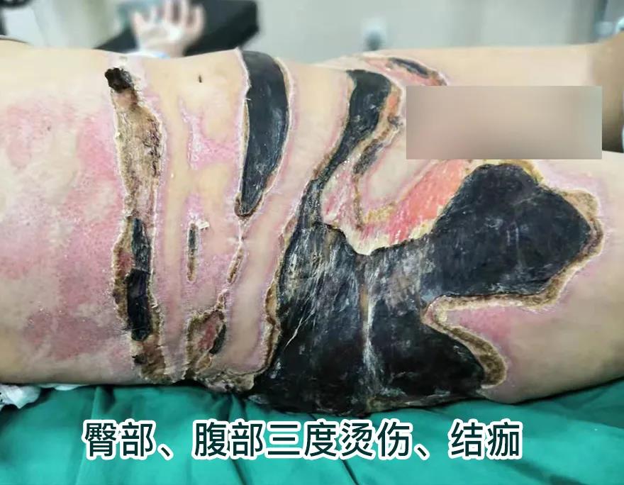 【保山安利醫(yī)院】80歲老人不慎燒傷，導致腹部、右側臀部大面積創(chuàng)傷，經(jīng)植皮治療創(chuàng)面逐漸愈合