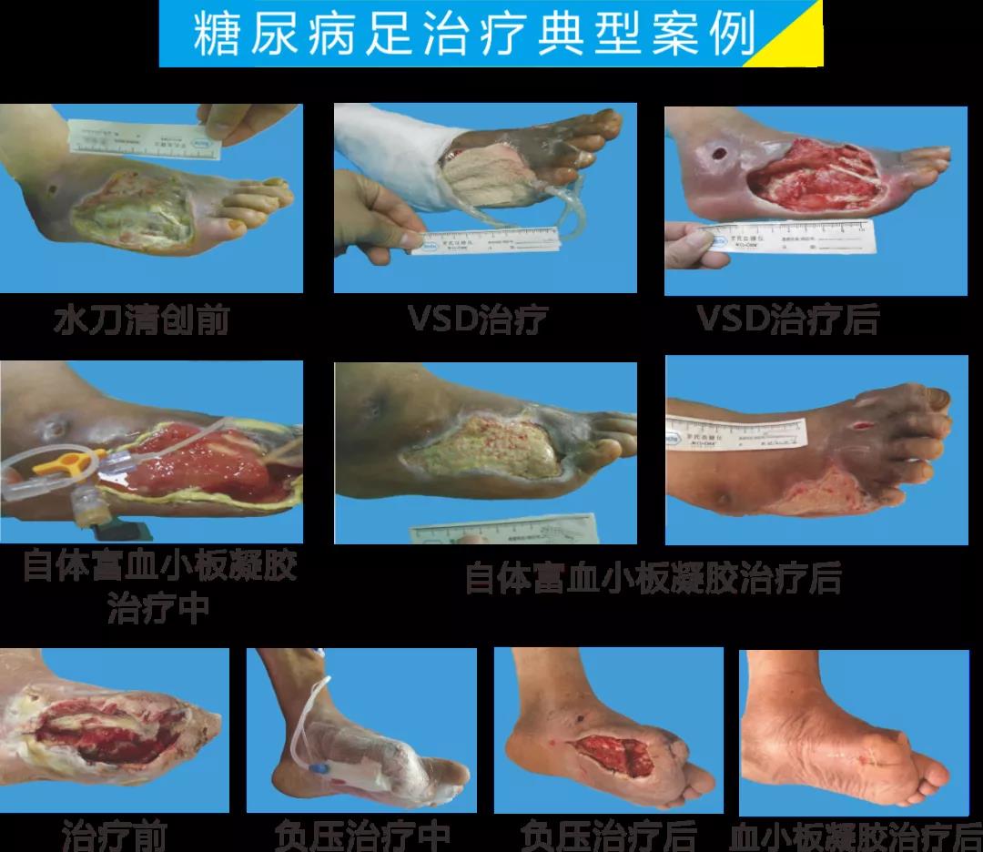 截肢、失明，甚至……，我們要做的是將糖尿病并發(fā)癥遏制在搖籃里！