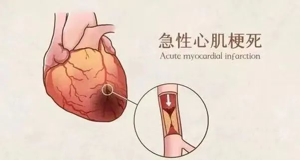 【保山安利醫(yī)院】11月20日“心梗救治日” 時(shí)間就是心肌，時(shí)間就是生命！