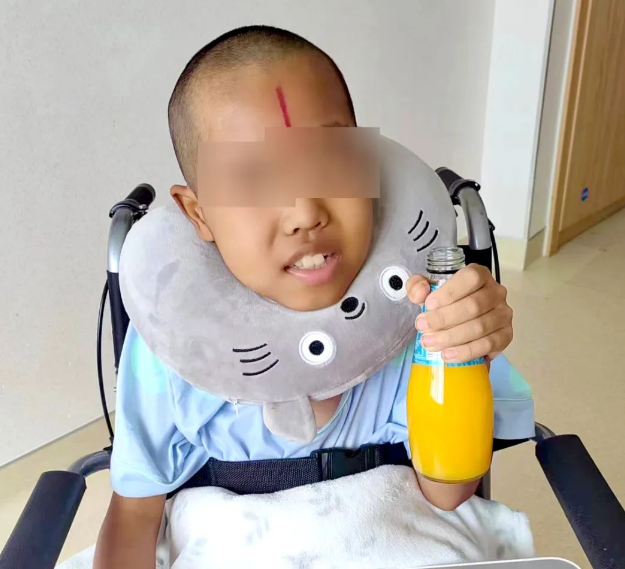 10歲腦干膠質瘤患兒經23次放療后病情明顯好轉